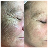 Skinbooster kuur - chronos behandeling